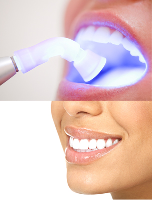 Whitening